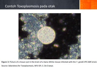 Contoh Toxoplasmosis pada otak

 