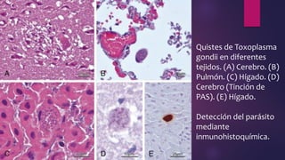 Quistes de Toxoplasma
gondii en diferentes
tejidos. (A) Cerebro. (B)
Pulmón. (C) Hígado. (D)
Cerebro (Tinción de
PAS). (E) Hígado.
Detección del parásito
mediante
inmunohistoquímica.
 