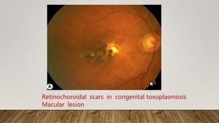 Retinochoroidal scars in congenital toxoplasmosis
Macular lesion
 