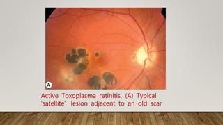 Active Toxoplasma retinitis. (A) Typical
‘satellite’ lesion adjacent to an old scar
 