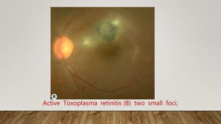 Active Toxoplasma retinitis (B) two small foci;
 