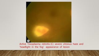 Active Toxoplasma retinitis (C) severe vitreous haze and
‘headlight in the fog’ appearance of lesion
 
