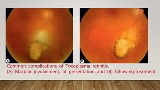 Common complications of Toxoplasma retinitis.
(A) Macular involvement, at presentation and (B) following treatment;
 