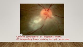Common complications of Toxoplasma retinitis.
(C) juxtapapillary lesion involving the optic nerve head
 