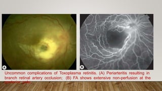 Uncommon complications of Toxoplasma retinitis. (A) Periarteritis resulting in
branch retinal artery occlusion; (B) FA shows extensive non-perfusion at the
posterior pole;
 