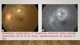 Uncommon complications of Toxoplasma retinitis.(C) serous macular
detachment; (D) FA of (C) shows hyperﬂuorescence d/t pooling of
dye;
 