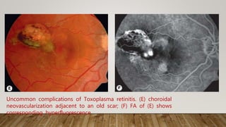 Uncommon complications of Toxoplasma retinitis. (E) choroidal
neovascularization adjacent to an old scar; (F) FA of (E) shows
corresponding hyperﬂuorescence
 