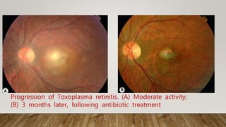 Progression of Toxoplasma retinitis. (A) Moderate activity;
(B) 3 months later, following antibiotic treatment
 