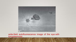 wide-field autoﬂuorescence image of the eye with
toxoplasmosis
 