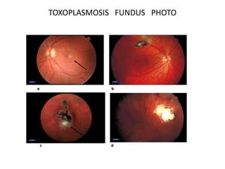 TOXOPLASMOSIS FUNDUS PHOTO
 