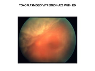 TOXOPLASMOSIS VITREOUS HAZE WITH RD
 