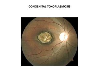 CONGENITAL TOXOPLASMOSIS
 