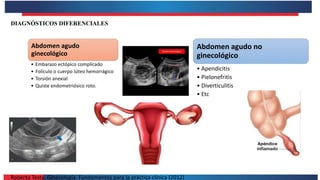 Roberto Testa. Ginecología. Fundamentos para la práctica clínica (2012)
DIAGNÓSTICOS DIFERENCIALES
Abdomen agudo
ginecológico
• Embarazo ectópico complicado
• Folículo o cuerpo lúteo hemorrágico
• Torsión anexial
• Quiste endometriósico roto.
Abdomen agudo no
ginecológico
• Apendicitis
• Pielonefritis
• Diverticulitis
• Etc
 