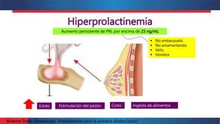Hiperprolactinemia
 No embarazada
 No amamantando
 Niño
 Hombre
Aumento persistente de PRL por encima de 25 ng/mL
Estimulación del pezón
Estrés Ingesta de alimentos
Coito
Roberto Testa. Ginecología. Fundamentos para la práctica clínica (2012)
 