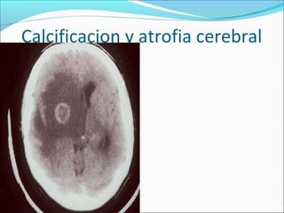 Calcificacion y atrofia cerebral
 