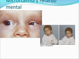 Microftalmia y retardo
mental
 