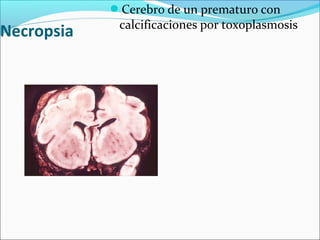 Necropsia
Cerebro de un prematuro con
calcificaciones por toxoplasmosis
 