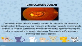 TOXOPLASMOSIS OCULAR 
Causa coriorretinitis debido a infección prenatal. Se caracteriza por inflamación 
granulomatosa del tracto uveal que comienza por la retina y después compromete la 
coroides. La lesión es casi siempre redondeada con bordes pigmentados y la parte 
central es blanquecina de aspecto algodonosa. Disminuye la visión y en casos 
crónicos puede causar ceguera. 
 