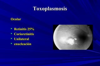 ToxoplasmosisToxoplasmosis
OcularOcular
 Retinitis 25%Retinitis 25%
 CorioretinitisCorioretinitis
 UnilateralUnilateral
 enucleaciónenucleación
 