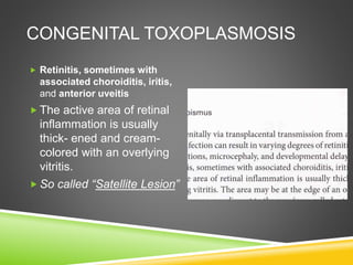 CONGENITAL TOXOPLASMOSIS
 Retinitis, sometimes with
associated choroiditis, iritis,
and anterior uveitis
 The active area of retinal
inflammation is usually
thick- ened and cream-
colored with an overlying
vitritis.
 So called “Satellite Lesion”
 