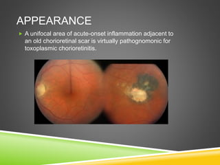 APPEARANCE
 A unifocal area of acute-onset inflammation adjacent to
an old chorioretinal scar is virtually pathognomonic for
toxoplasmic chorioretinitis.
 