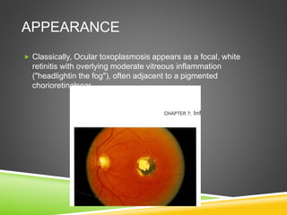 APPEARANCE
 Classically, Ocular toxoplasmosis appears as a focal, white
retinitis with overlying moderate vitreous inflammation
("headlightin the fog"), often adjacent to a pigmented
chorioretinalscar
 