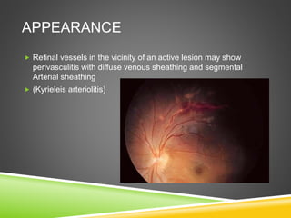 APPEARANCE
 Retinal vessels in the vicinity of an active lesion may show
perivasculitis with diffuse venous sheathing and segmental
Arterial sheathing
 (Kyrieleis arteriolitis)
 