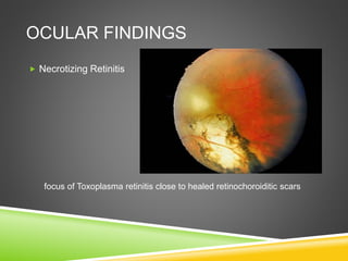 OCULAR FINDINGS
 Necrotizing Retinitis
focus of Toxoplasma retinitis close to healed retinochoroiditic scars
 