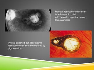 Typical punched-out Toxoplasma
retinochoroiditic scar surrounded by
pigmentation.
Macular retinochoroiditic scar
in a 6-year-old child
with healed congenital ocular
toxoplasmosis
 