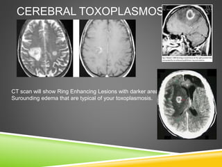 CEREBRAL TOXOPLASMOSIS
CT scan will show Ring Enhancing Lesions with darker areas of
Surounding edema that are typical of your toxoplasmosis.
 