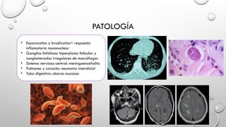 PATOLOGÍA
• Esporozoitos y bradizoitos= respuesta
inflamatoria mononuclear
• Ganglios linfáticos: hiperplasia folicular y
conglomerados irregulares de macrófagos
• Sistema nervioso central: meningoencefalitis
• Pulmones y corazón: neumonía intersticial
• Tubo digestivo: ulceras mucosas
 