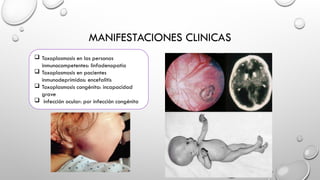 MANIFESTACIONES CLINICAS
 Toxoplasmosis en las personas
inmunocompetentes: linfadenopatia
 Toxoplasmosis en pacientes
inmunodeprimidos: encefalitis
 Toxoplasmosis congénita: incapacidad
grave
 infección ocular: por infección congénita
 