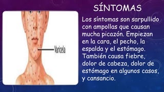 SÍNTOMAS
Los síntomas son sarpullido
con ampollas que causan
mucha picazón. Empiezan
en la cara, el pecho, la
espalda y el estómago.
También causa fiebre,
dolor de cabeza, dolor de
estómago en algunos casos,
y cansancio.
 
