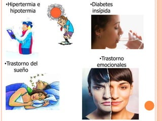 •Hipertermia e 
hipotermia 
•Diabetes 
insípida 
•Trastorno del 
sueño 
•Trastorno 
emocionales 
 