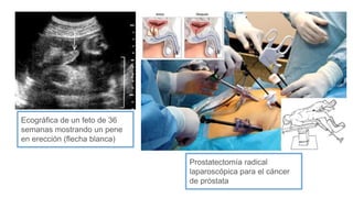 Ecográfica de un feto de 36
semanas mostrando un pene
en erección (flecha blanca)
Prostatectomía radical
laparoscópica para el cáncer
de próstata
 