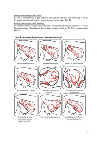 7
Presentación transversal de dorso:
El feto se encuentra con el dorso ubicado transversalmente frete a la entrada de la pelvis.
Es una de las más desfavorables aunque de ocurrencia escasa. (Fig. 4).
Presentación transversal de abdomen:
El feto se encuentra ubicado transversalmente por delante del estrecho anterior de la pelvis;
las extremidades y la cabeza se dirigen hacia el canal obstétrico. Es de frecuencia escasa.
(Fig. 4).
Figura 4: ejemplos de distocia debido a estática fetal anormal.
 