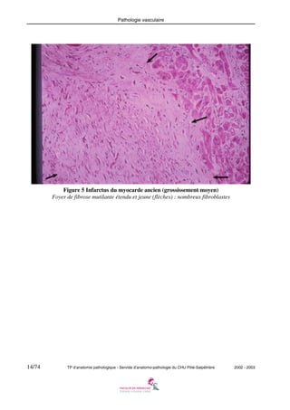 Pathologie vasculaire

Figure 5 Infarctus du myocarde ancien (grossissement moyen)
Foyer de fibrose mutilante étendu et jeune (flèches) : nombreux fibroblastes

14/74

TP d’anatomie pathologique - Servide d’anatomo-pathologie du CHU Pitié-Salpêtrière

2002 - 2003

 