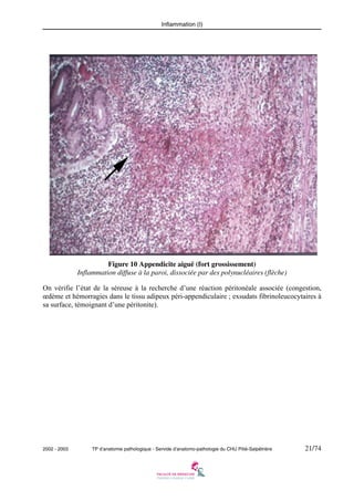 Inflammation (I)

Figure 10 Appendicite aiguë (fort grossissement)
Inflammation diffuse à la paroi, dissociée par des polynucléaires (flèche)
On vérifie l’état de la séreuse à la recherche d’une réaction péritonéale associée (congestion,
œdème et hémorragies dans le tissu adipeux péri-appendiculaire ; exsudats fibrinoleucocytaires à
sa surface, témoignant d’une péritonite).

2002 - 2003

TP d’anatomie pathologique - Servide d’anatomo-pathologie du CHU Pitié-Salpêtrière

21/74

 