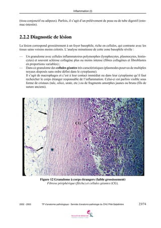 Inflammation (I)

(tissu conjonctif ou adipeux). Parfois, il s’agit d’un prélèvement de peau ou de tube digestif (estomac-intestin).

2.2.2 Diagnostic de lésion
La lésion correspond grossièrement à un foyer basophile, riche en cellules, qui contraste avec les
tissus sains voisins moins colorés. L’analyse minutieuse de cette zone basophile révèle :
—
—

Un granulome avec cellules inflammatoires polymorphes (lymphocytes, plasmocytes, histiocytes) et souvent sclérose collagène plus ou moins intense (fibres collagènes et fibroblastes
en proportions variables) ;
Dans ce granulome des cellules géantes très caractéristiques (plasmodes pourvus de multiples
noyaux disposés sans ordre défini dans le cytoplasme).
Il s’agit de macrophages et c’est à leur contact immédiat ou dans leur cytoplasme qu’il faut
rechercher le corps étranger responsable de l’inflammation. Celui-ci est parfois visible sous
forme de cristaux (talc, silice, urate, etc.) ou de fragments amorphes jaunes ou bruns (fils de
suture anciens).

Figure 12 Granulome à corps étrangers (faible grossissement)
Fibrose périphérique (flèche) et cellules géantes (CG).

2002 - 2003

TP d’anatomie pathologique - Servide d’anatomo-pathologie du CHU Pitié-Salpêtrière

23/74

 