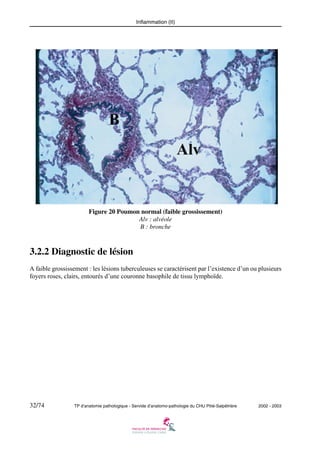 Inflammation (II)

Figure 20 Poumon normal (faible grossissement)
Alv : alvéole
B : bronche

3.2.2 Diagnostic de lésion
A faible grossissement : les lésions tuberculeuses se caractérisent par l’existence d’un ou plusieurs
foyers roses, clairs, entourés d’une couronne basophile de tissu lymphoïde.

32/74

TP d’anatomie pathologique - Servide d’anatomo-pathologie du CHU Pitié-Salpêtrière

2002 - 2003

 