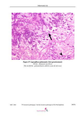 Inflammation (II)

Figure 27 Aspergillose pulmonaire (fort grossissement)
Flèche : filaments mycéliens
Tête de flèche : polynucléaires altérés (zone de nécrose)

2002 - 2003

TP d’anatomie pathologique - Servide d’anatomo-pathologie du CHU Pitié-Salpêtrière

39/74

 