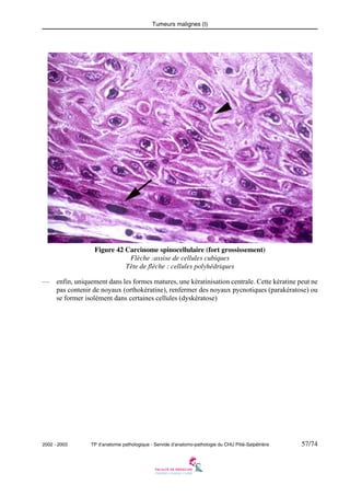 Tumeurs malignes (I)

Figure 42 Carcinome spinocellulaire (fort grossissement)
Flèche :assise de cellules cubiques
Tête de flèche : cellules polyhédriques
—

enfin, uniquement dans les formes matures, une kératinisation centrale. Cette kératine peut ne
pas contenir de noyaux (orthokératine), renfermer des noyaux pycnotiques (parakératose) ou
se former isolément dans certaines cellules (dyskératose)

2002 - 2003

TP d’anatomie pathologique - Servide d’anatomo-pathologie du CHU Pitié-Salpêtrière

57/74

 