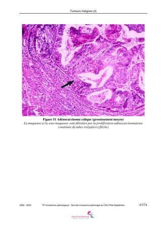 Tumeurs malignes (II)

Figure 51 Adénocarcinome colique (grossissement moyen)
La muqueuse et la sous-muqueuse sont détruites par la prolifération adénocarcinomateuse
constituée de tubes irréguliers (flèche)

2002 - 2003

TP d’anatomie pathologique - Servide d’anatomo-pathologie du CHU Pitié-Salpêtrière

67/74

 