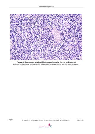 Tumeurs malignes (II)

Figure 58 Lymphome non hodgkinien ganglionnaire (fort grossissement)
Infiltrat diffus fait de petits lymphocytes dont le noyau contient une chromatine dense.

74/74

TP d’anatomie pathologique - Servide d’anatomo-pathologie du CHU Pitié-Salpêtrière

2002 - 2003

 
