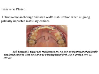 Transverse Plane :
1.Transverse anchorage and arch width stabilization when aligning
palatally impacted maxillary canines
Ref: Baccetti T, Sigler LM, McNamara JA. An RCT on treatment of palatally
displaced canines with RME and/or a transpalatal arch. Eur J Orthod 2011; 33:
601−607
 