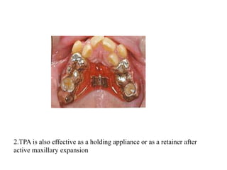 2.TPA is also effective as a holding appliance or as a retainer after
active maxillary expansion
 