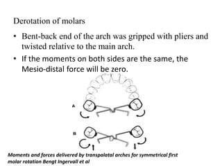 Derotation of molars
• Bent-back end of the arch was gripped with pliers and
twisted relative to the main arch.
• If the moments on both sides are the same, the
Mesio-distal force will be zero.
Moments and forces delivered by transpalatal arches for symmetrical first
molar rotation Bengt Ingervall et al
 
