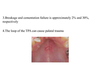 3.Breakage and cementation failure is approximately 2% and 30%,
respectively
4.The loop of the TPA can cause palatal trauma
 