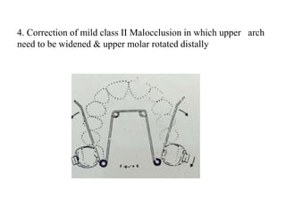 4. Correction of mild class II Malocclusion in which upper arch
need to be widened & upper molar rotated distally
 