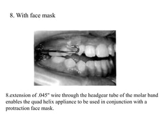 8. With face mask
8.extension of .045" wire through the headgear tube of the molar band
enables the quad helix appliance to be used in conjunction with a
protraction face mask.
 